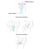 Terpan female condom (1 pc)